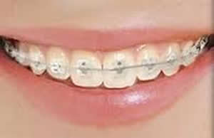 GAC Self Ligating Ceramic Braces at Cavan Braces