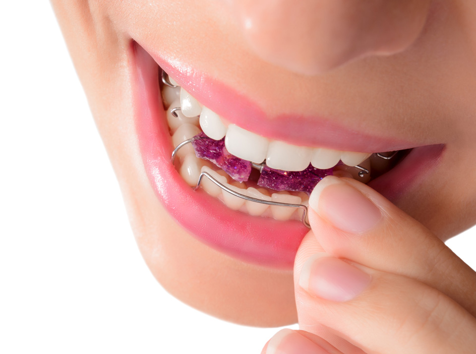 Affordable Orthodontic Treatment Prices - Removable Appliances at Cavan Braces